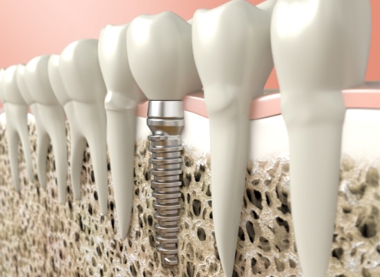 Animated smile after bone grafting treatment