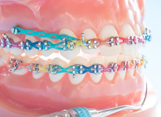 a model of a mouth showing how braces elastics work