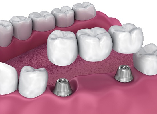Digital image of an implant partial