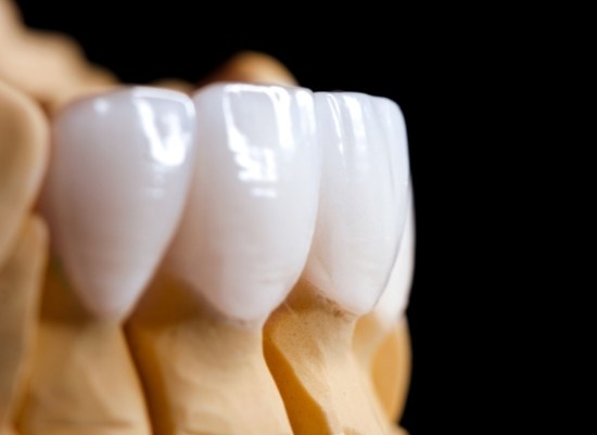 Model smile with all ceramic dental crown supported bridge