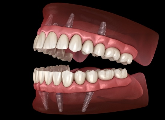 Animated smile with all on four dental implants