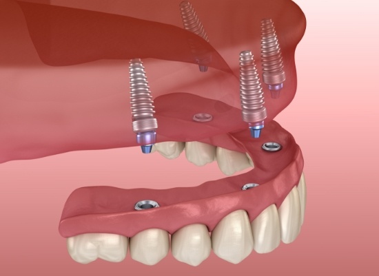Animated smile during all on four dental implant placement