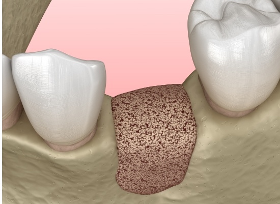 Animated smile after osseous surgery