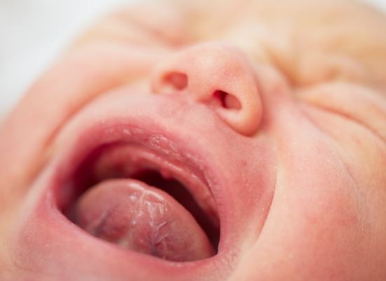 Crying baby in need of frenectomy for lip and tongue tie