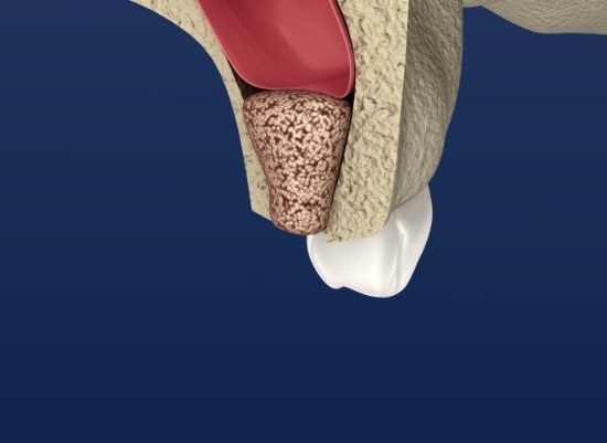 Animated smile after ridge augmentation