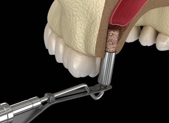 Animated smile during sinus augmentation