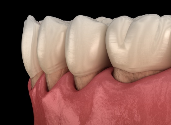 Animated smile in need of pocket reduction surgery