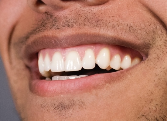Closeup of smile after canine exposure