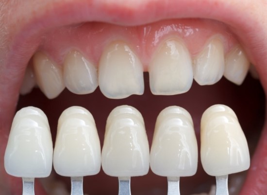 Closeup of smile compared with porcelain veneer shade chart