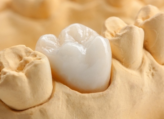 Model smile with dental crown restoration