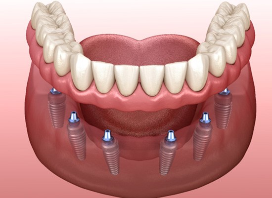 A 3D illustration of implant dentures