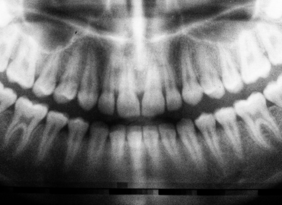 Panorex digital dental x-rays