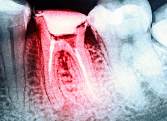 X-ray of damaged tooth in need of root canal therapy