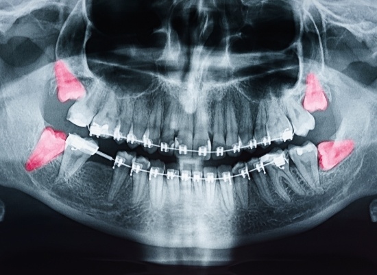 X-ray of impacted wisdom teeth in need of extraction