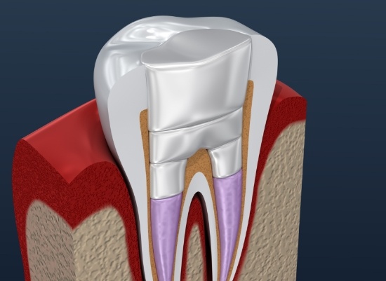 Animated smile after extraction site preservation