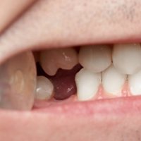 Closeup of smile with knocked out tooth