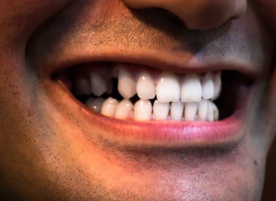 Closeup of smile with missing tooth after extraction site preservation