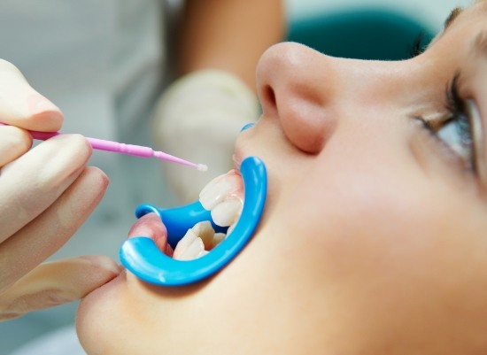 Patient receiving fluoride treatment