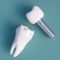 Dental implant and tooth mold in Houston