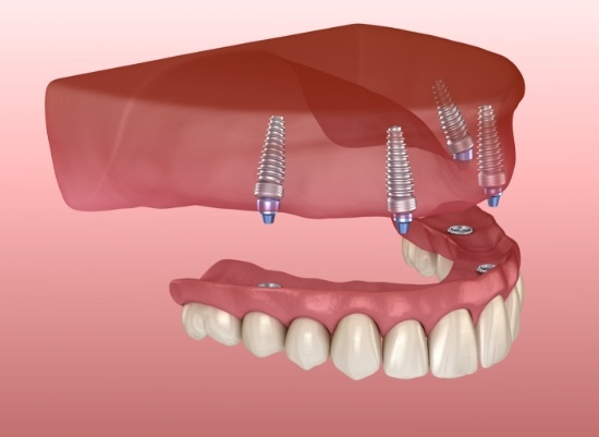 Animated smile during dental implant supported denture placement