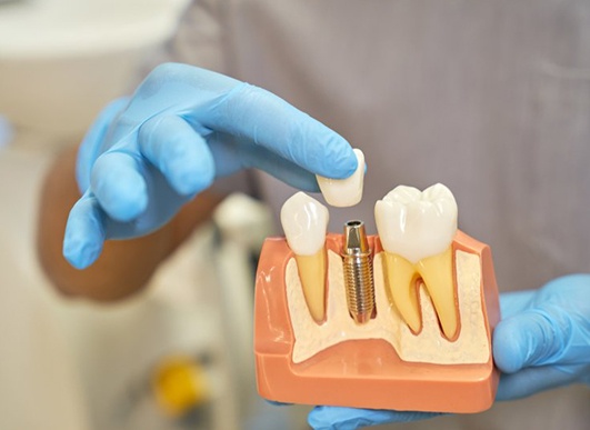 dentist holding a model of a dental implant 
