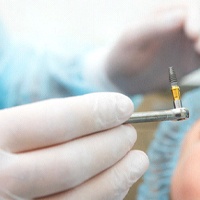 Houston implant dentist using X-Mark technology in Houston