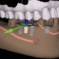 Closeup of digital representation of computer guided dental implant surgery in Houston