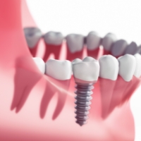 Animated smile with dental implant supported dental crown