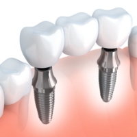 Animated smile with dental implant supported fixed bridge