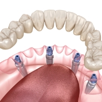 Animated smile with dental implant supported denture