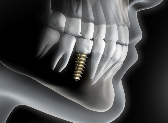 Animated smile with dental implant supported dental crown