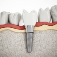 Animated smile during dental implant osseointegration