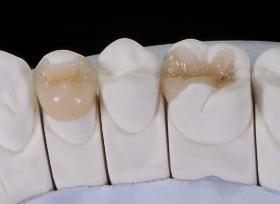 Model smile with inlay and only restoration