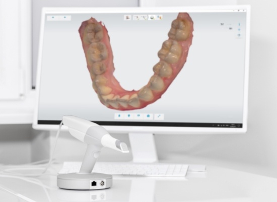 Digital impression of smile during inlay and onlay treatment planning