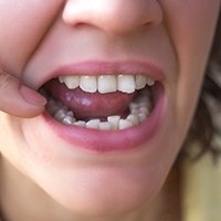 Woman pointing to her lower arch of crooked teeth