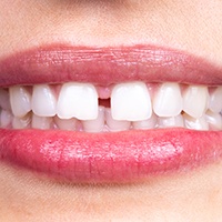 Closeup of someone’s smile with diastema in upper front teeth