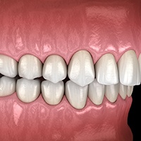 Profile view of illustrated overbite with black background