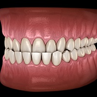 profile view illustration of underbite with black background