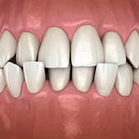 3D illustration of frontal view of crossbite with black background