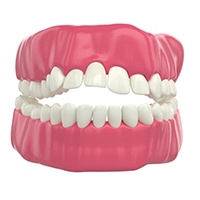Frontal view illustration of an open bite with white background