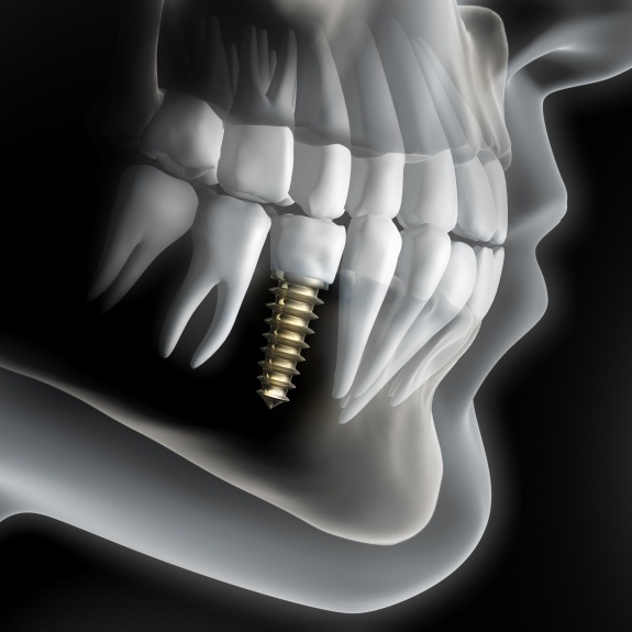 graphic of dental implant