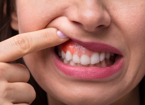 Closeup of smile with signs of oral cancer