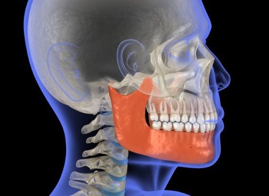 3 D animation outlining orthognathic surgery