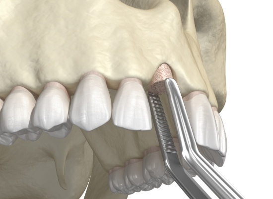 Animated smile during osseous surgery