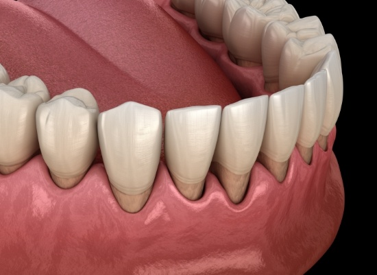 Animated smile in need of periodontal splinting