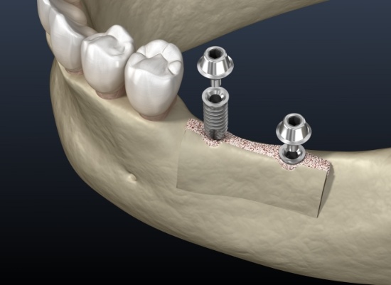 Animated smile with dental implants placed after ridge augmentation