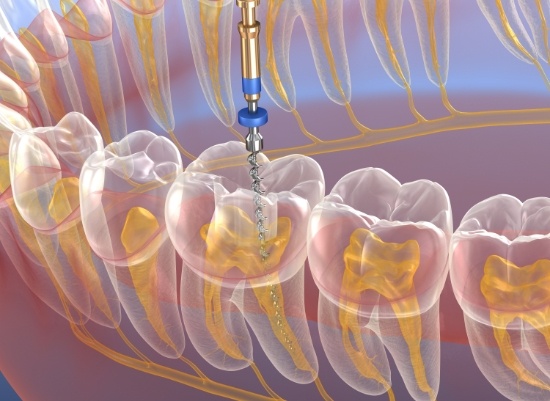 Animated smile during root canal therapy