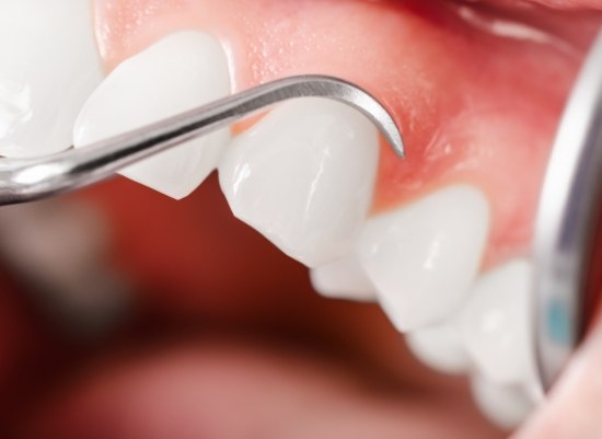 Closeup of smile during sclaing and root planing