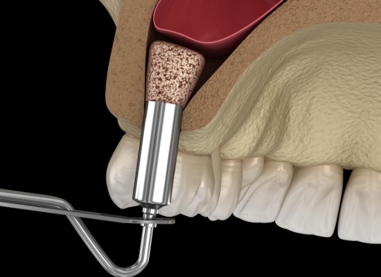 Animated smile during sinus augmentation