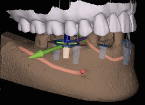 Dynamic guide for implant surgery on computer screen